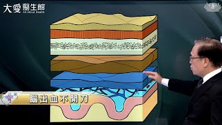 【大愛醫生館】腦出血不開刀 20230109