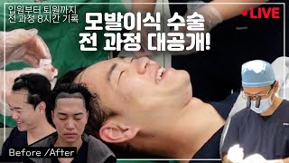 무삭발 비절개 모발이식 수술 과정 전부 공개합니다