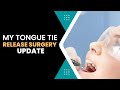 My Tongue Tie Release Surgery Update