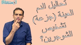 كيفية تشخيص مرض الشوجرين (التحاليل والعينة (الجزعة) | الاستشاري