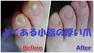 肥厚爪の施術【厚い爪のケア】（Thickened nails・THICK TOENAIL・두꺼워 손톱・足の爪切り）009