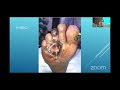 Vascular online training Prof Martin maresch lecture on deep venous arterlization