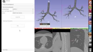 Virtual bronchoscopy at University College Cork