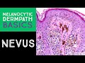 Melanocytic Dermpath Basics: Benign Nevus