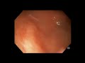 esd of rectal carcinoid with a focus on endoscopic suturing