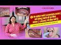 मुँह के सफ़ेद धब्बे (LEUKOPLAKIA)को घरेलू उपाय से या फिर लेज़र ( LASER) से ठीक करें ||