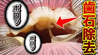 【歯石がボロッ】歯石撃退! 歯の隙間にこびりつく頑固な歯石たち【歯石除去】tartar removal