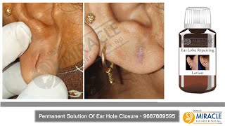 Torn Ear lobe repaired  Earlobe / Hole Repair by Ear Pasting lotion / Glue - Call -  9687889595