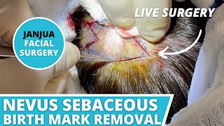 NEVUS SEBACEOUS ON SCALP (BIRTH MARK REMOVAL) (LIVE SURGERY) - DR. TANVEER JANJUA - NEW JERSEY