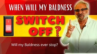 When will my Balding STOP? |  When will my Baldness Gene Switch OFF!