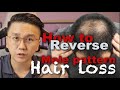 How to Reverse Male Pattern Baldness - Hair Loss in Men