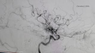 May is Stroke Awareness Month: Here are the warning signs to know