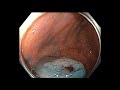 Ascending colon - Subtle flat lesion behind a fold in the RUQ - EMR