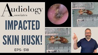 DEEP IMPACTED SKIN HUSK REMOVAL - EP518