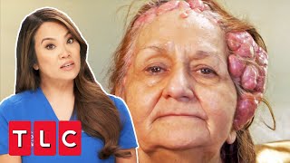 Woman Has Over 100 Cysts On Her Head | Dr Pimple Popper This Is Zit