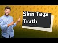 Do skin tags fall off naturally?