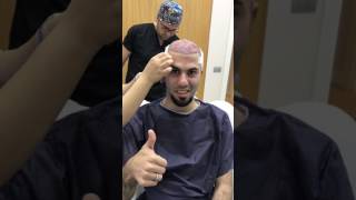 5200 graft fue hairtransplant İSTANBUL