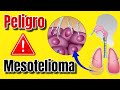 ¿Qué es el MESOTELIOMA CANCER y Cómo TRATARLO Benigno Maligno Difuso 2024