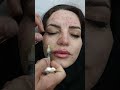 نحوه ی تزریق مزوزوژل ها دکتر امید https instagram.com dr_omiid