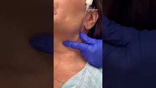 Hyperdiluted Radiesse can be used in the neck/chest to stimulate collagen production #dermalfiller