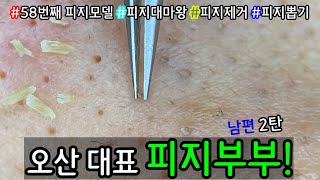 피지 직접 뽑아드렸습니다 _ 피지제거 블랙헤드제거 피지뽑기 _  오산 피지부부 먼저 남편 피지짱 먼저 피지를 박살냈습니다 2탄