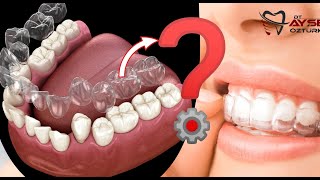 Orthodontic Treatment with Clear Aligners - invisalign time lapse - invisalign process