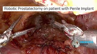 Robotic Prostatectomy on patient with Penile Implant - Amazing technique