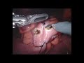 robotic ileocolic and sigmoid resection for crohn s disease