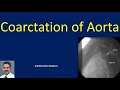 Coarctation of Aorta