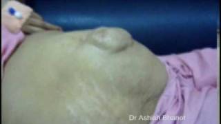 Divarication of Recti Umbilical Hernia