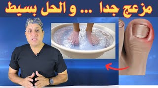 أخيراً  الحل الأفضل لمشكلة الظفر الغائر المزعج!