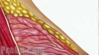 Breast Biopsy Needle Surgery - PreOp Patient Education Medical HD