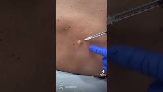 #mole #moles #nevus #nevi #birthmark #biopsy #beautymark #bocaraton #ftlauderdale #delraybeach