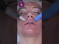 7 step skin needling treatment step by step procedure performance tutorial level 4 vtct course