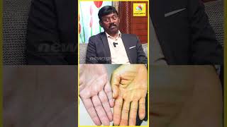 கல்லீரல் BILIRUBIN 25 மஞ்சள் காமாலை  குணப்படுத்த முடியுமா| Aayushmaan hospitals |