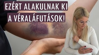 🤕Kék, zöld, lila foltok a bőrön: ezért alakulnak ki a véraláfutások - hillvital.hu