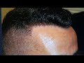 FUE PROCEDURE SUCCESS: 1- YEAR RESULTS BY MEDICAL HAIR TRANSPLANT AND AESTHETICS.