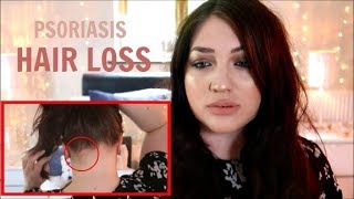 MY HAIR LOSS AND PSORIASIS STORY  ♡