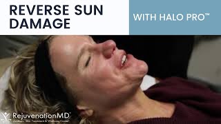 See Halo Pro™ Hybrid Fractional Laser In Action! Reverse Sun Damage