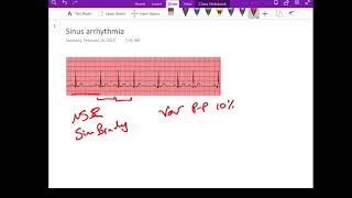 Sinus Arrhythmia - Dr Jamal USMLE -  cardiology ECG lecture