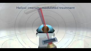 V TomoTherapy Hi Art Treatment Animation narrated