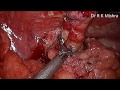 laparoscopic management of ruptured appendix