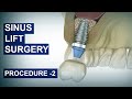 Sinus Lift Surgery in 3D Animation | Procedure-2 | Frontal Access