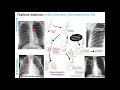 04.3 neumonía tb epoc enfisema bronquitis bronquiectasias asma