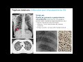 04.3 neumonía tb epoc enfisema bronquitis bronquiectasias asma