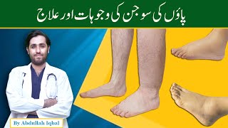 Edema | Causes of Pitting and Non Pitting Edema | Paon mein Sujan ki wajohat - Leg Swelling causes