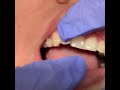 الزراعات التقويمية مع تقويم الانفزلاين Miniscrews with Invisalign