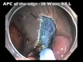 IC Valve Flat Lesion EMR   APC