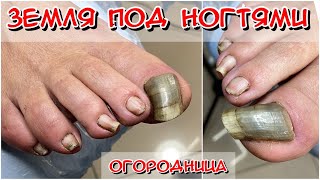 Земля под ногтями / Толстый ноготь / Онихогрифоз / Есть ли тут грибок? Что с ногтем?