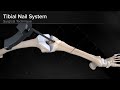 Tibial Nail System—Standard Surgical Technique